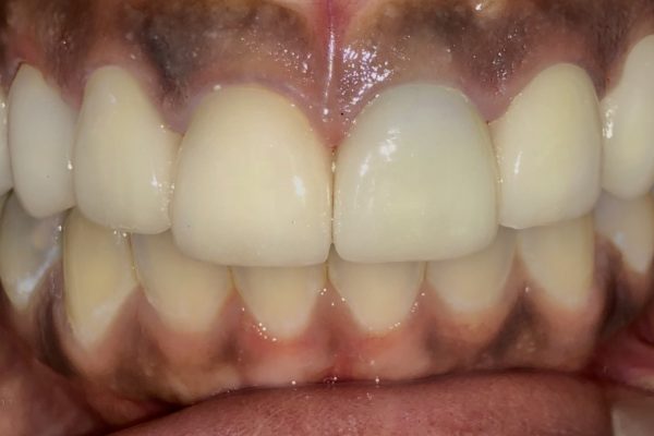 mock up of 3d smile desin in patients mouth
