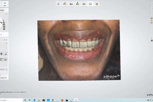 3d digital smile design