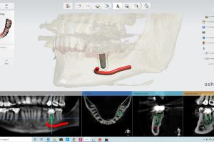 Digitally Placed Implant