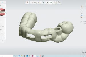 3d printable surgical guide