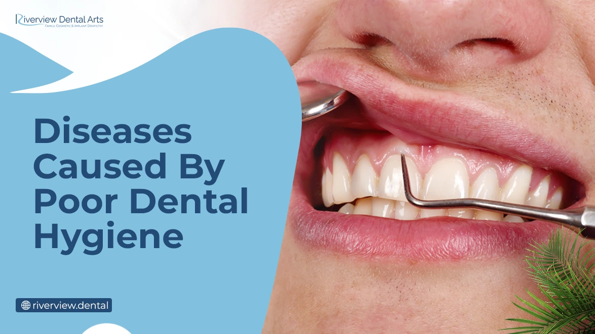 Diseases Caused By Poor Dental Hygiene