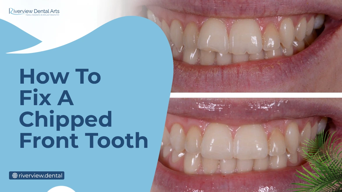 How to Fix a Chipped Front Tooth