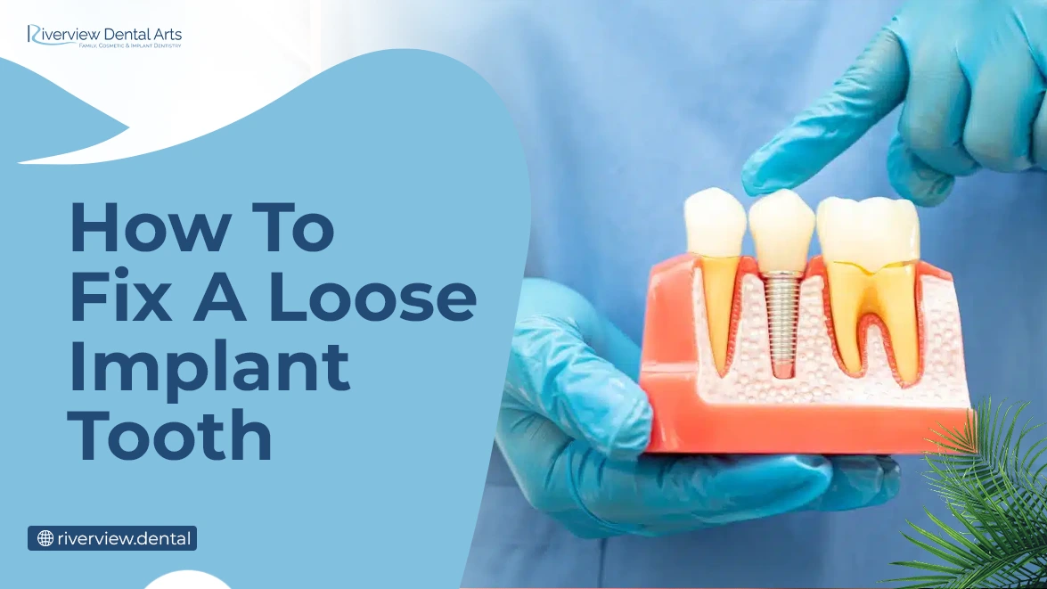 How to Fix a Loose Implant Tooth