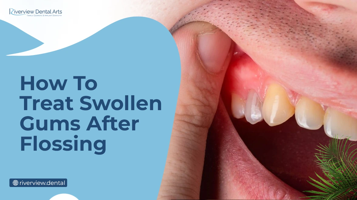 How to Treat Swollen Gums After Flossing
