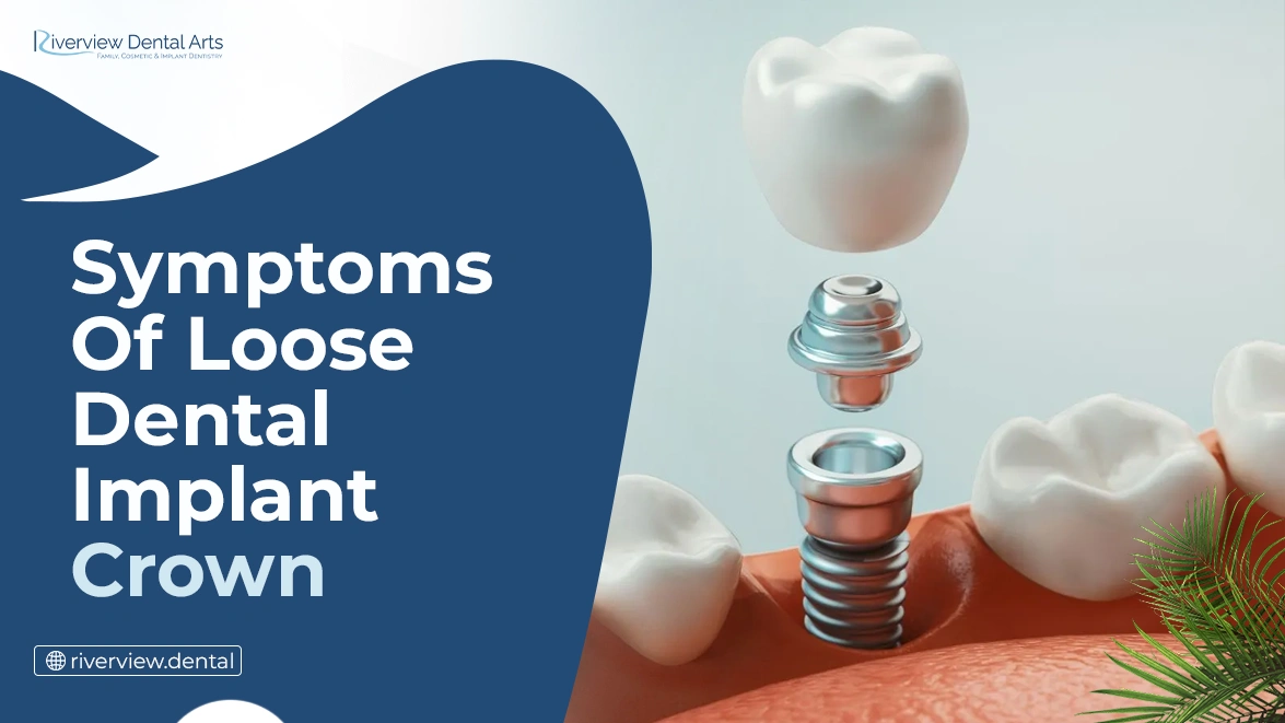 Symptoms of a Loose Dental Implant Crown