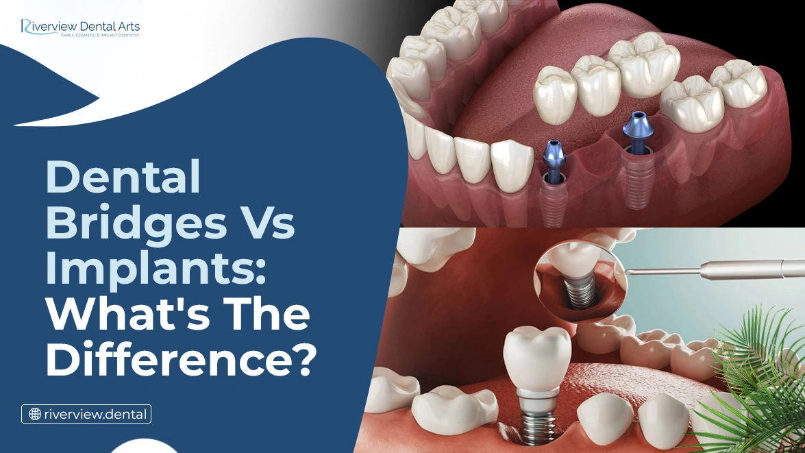 Dental Bridges vs. Implants: What’s the Difference?