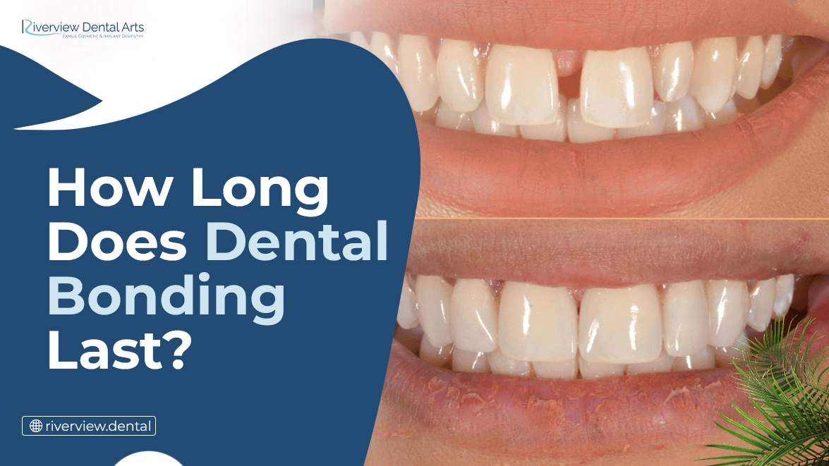 How Long Does Dental Bonding Last?