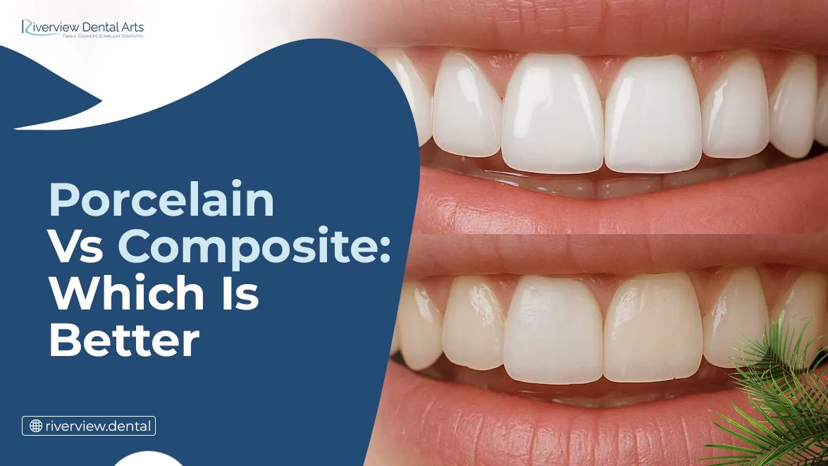 Porcelain vs. Composite Veneers