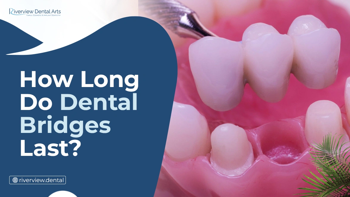How Long Do Dental Bridges Last?