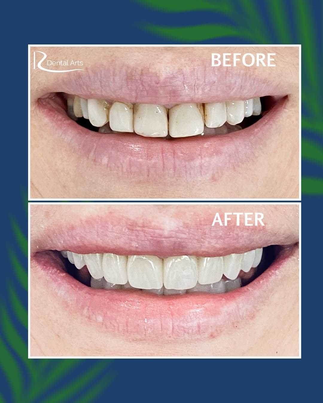 Choosing the Right Dental Crown for Your Needs