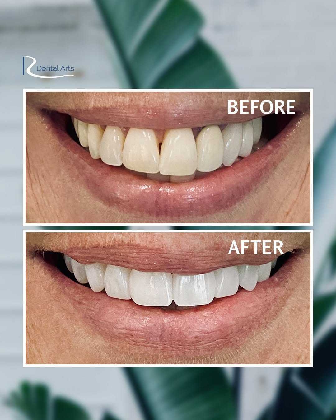 Understanding How the Procedure Is Performed