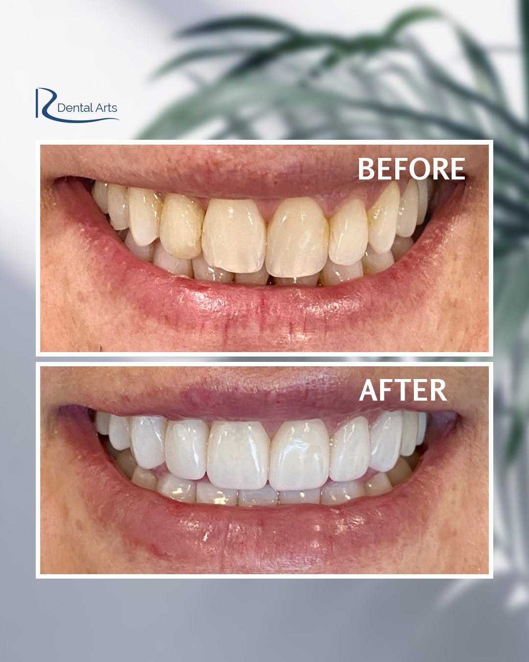 When Are Dental Crowns the Right Treatment Option