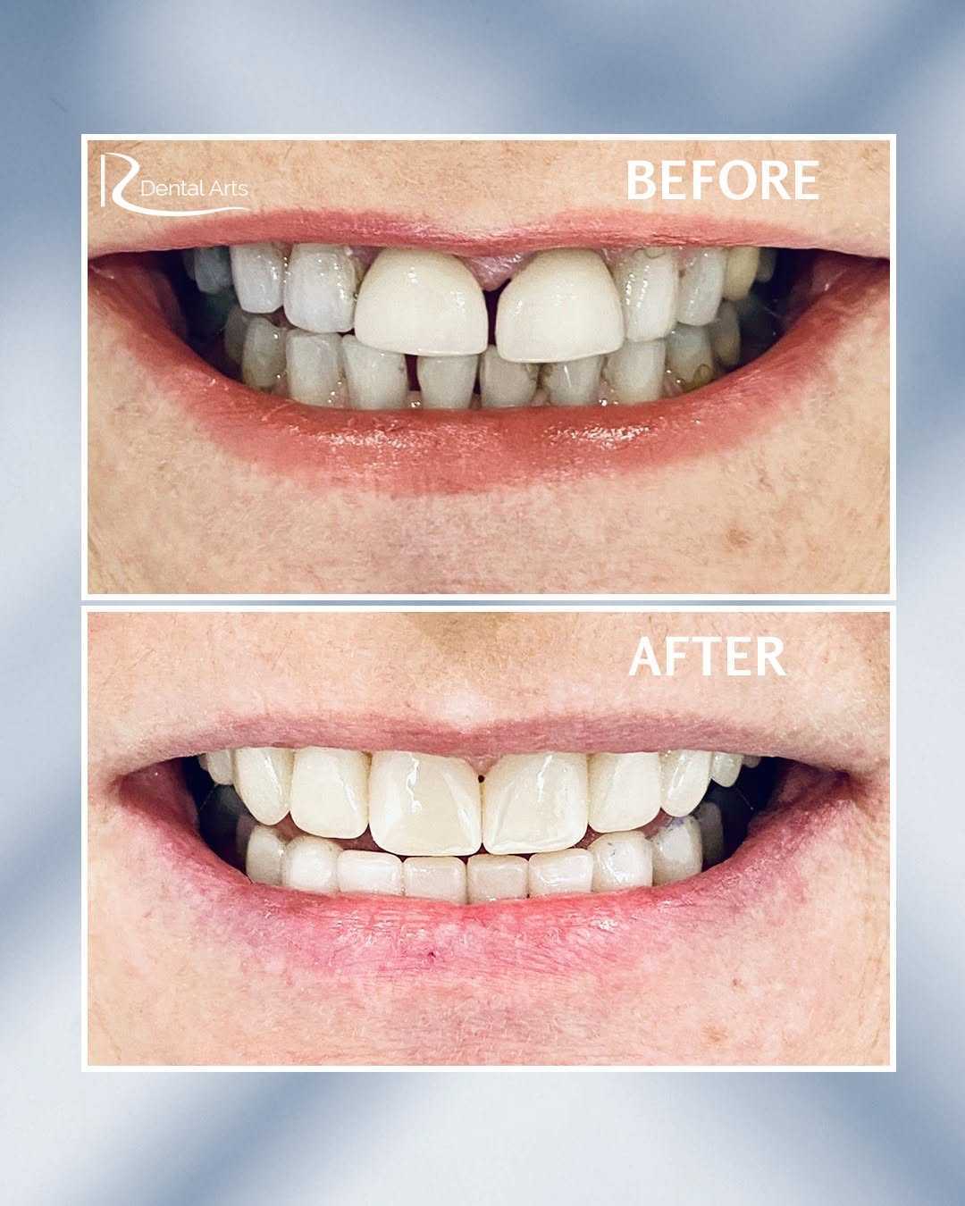 When Should You Choose Dental Veneers