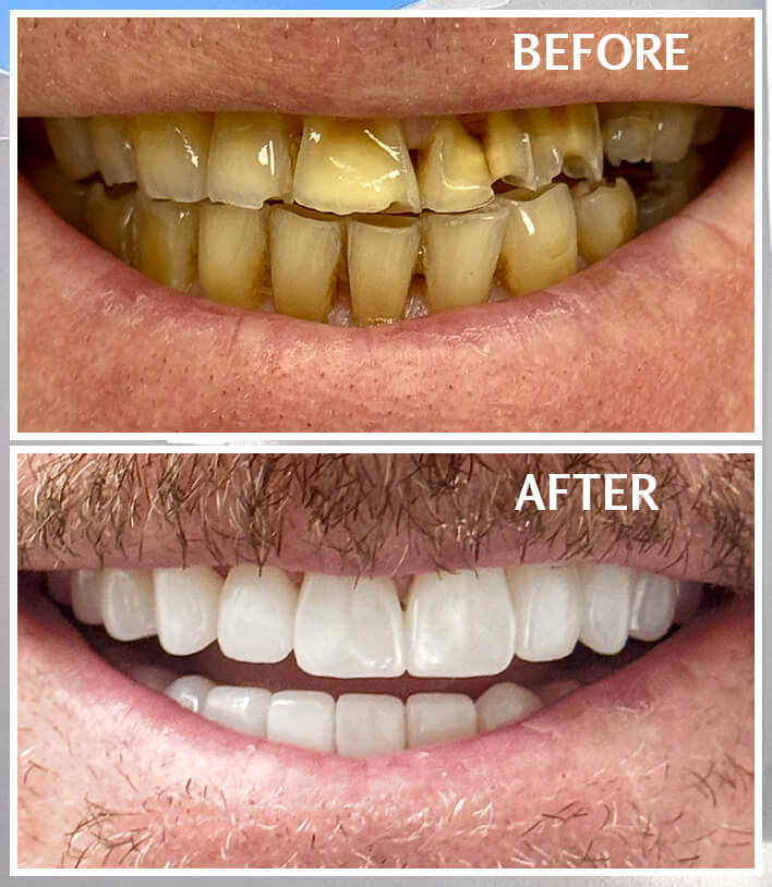 smile makeover Tampa before and after