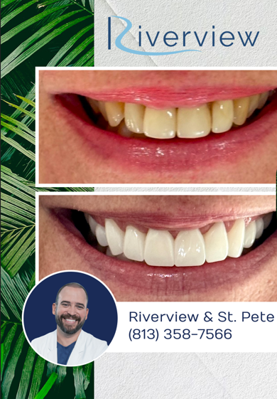 Before and after smile makeover with porcelain veneers in Riverview FL
