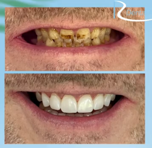 Before and after dental implant treatment at Riverview Dental Arts