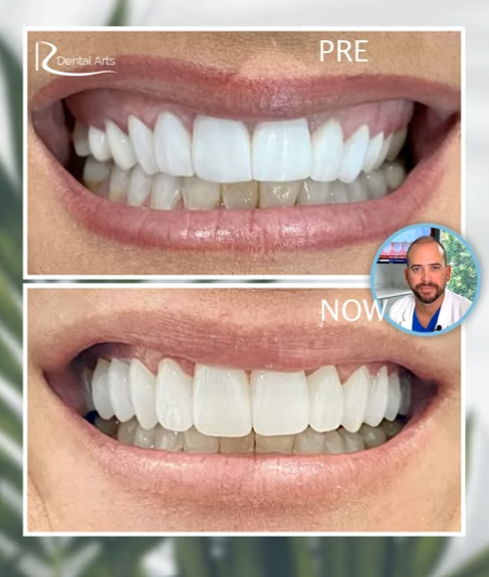 Before and after gum recontouring and veneers smile makeover in Riverview FL