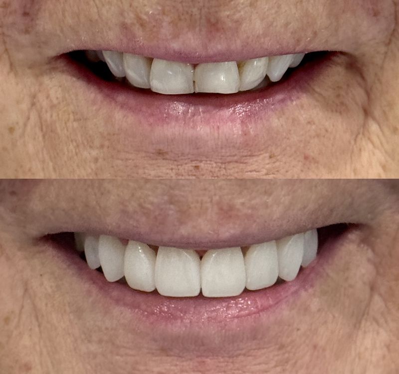 Smile makeover before and after with cosmetic crowns and veneers