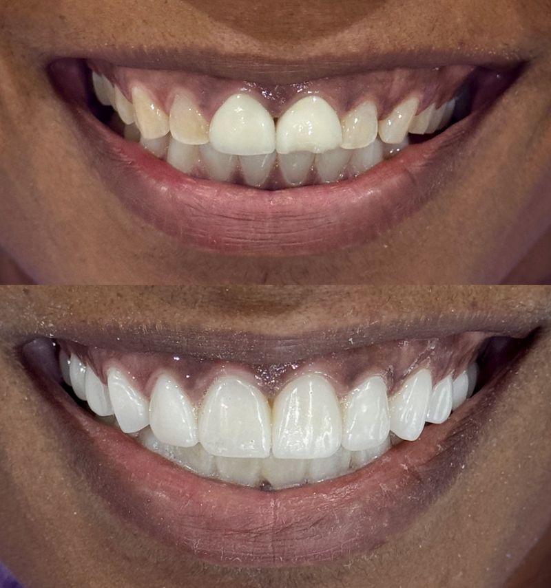 Smile makeover fixing old wide crowns with cosmetic ceramic crowns