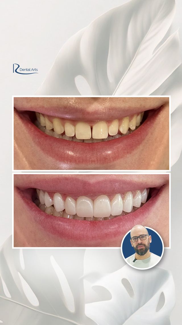 Before and after ceramic veneers after braces showing small teeth and gaps corrected with fuller, symmetrical smile