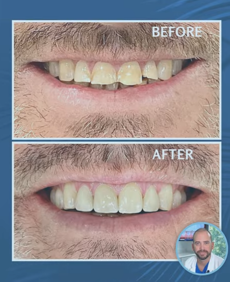 Before and after dental crowns for broken front teeth smile makeover