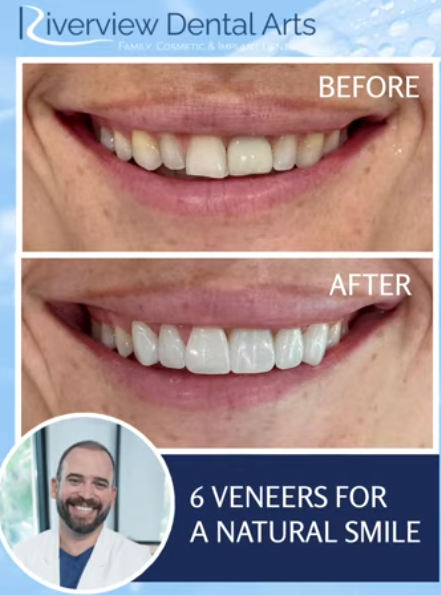 six teeth smile transformation before and after veneers Tampa Bay