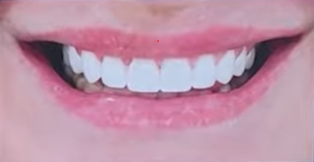 smile makeover results veneers and crowns before and after