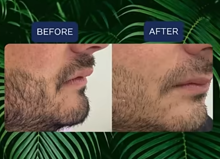 Can Veneers Fix Protruding Teeth