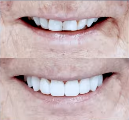 before and after veneers narrow smile Tampa smile widened natural result
