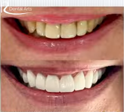 before and after same day dental crowns Tampa broken teeth restored natural smile