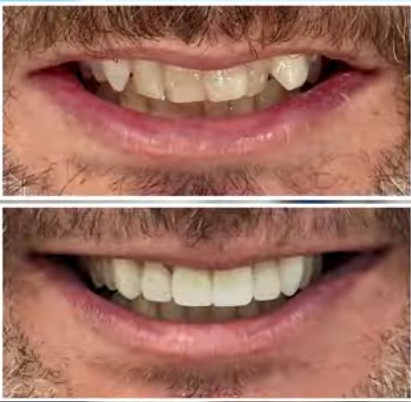 Before and after same-day smile makeover with dental crowns fixing broken front teeth in Tampa Bay