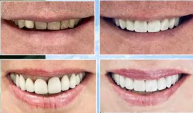 How do you choose the right dentist for your smile makeover