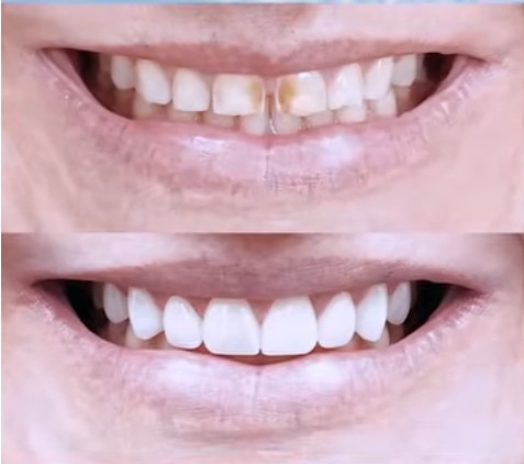 How to Fix a Gap in Front Teeth Without Braces 🦷 Smile Makeover