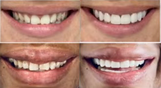 What Are The Side Effects Of A Smile Makeover