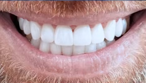 Gap Uneven Teeth Wrong Color Can Ceramic Veneers Fix All of It in Tampa Bay