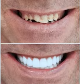 What Temporary Veneers Look Like Before the Final Result