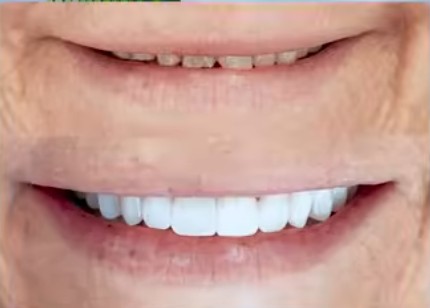 Why Do Your Teeth Look Shorter as You Age