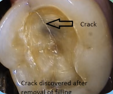 cracked